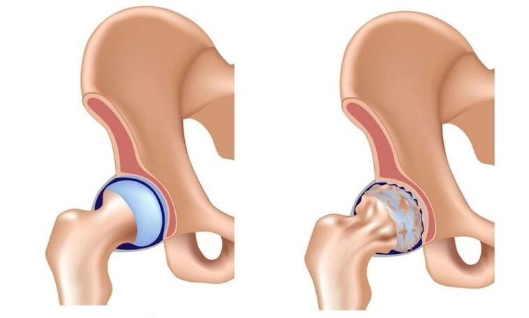 Articulation et articulation saines avec arthrose