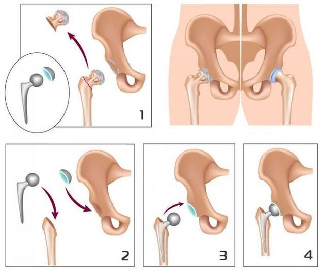 Remplacer un joint douloureux par une prothèse