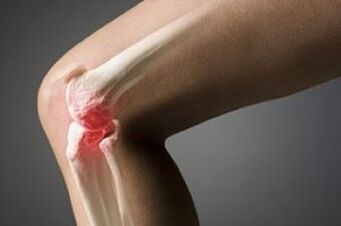 L'arthrose de l'articulation du genou est une lésion de tissu cartilage