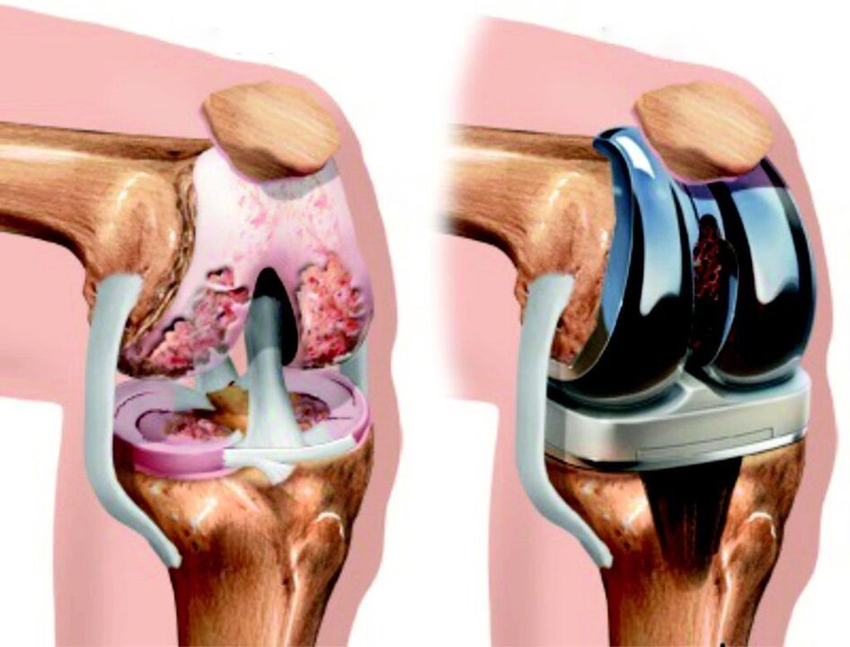 En cas de lésion totale de l'articulation du genou par arthrose, celle-ci peut être restaurée par endoprothèses
