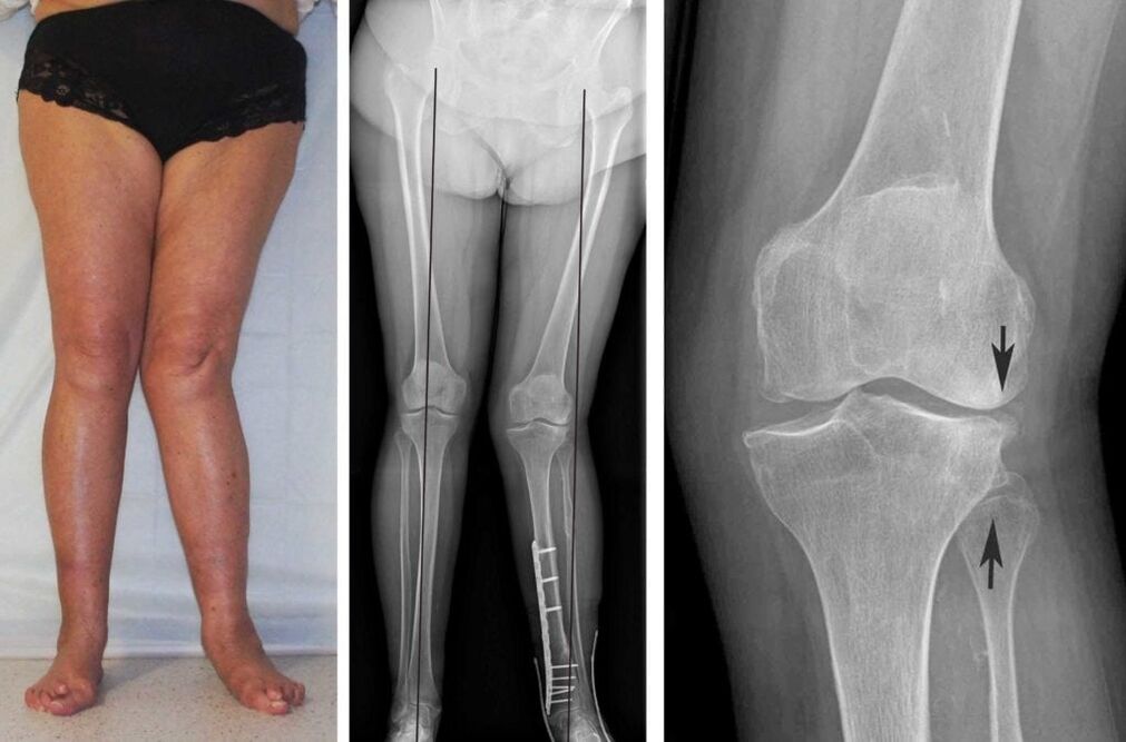 L'arthrose avancée des articulations du genou est clairement visible visuellement même sans radiographie