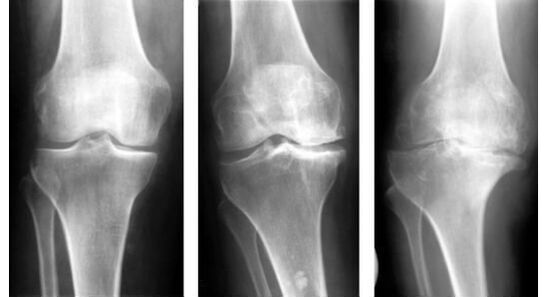 Une mesure diagnostique obligatoire lors de l'identification de l'arthrose du genou est une radiographie